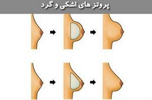 پروتز سينه اقساطي در مشهد